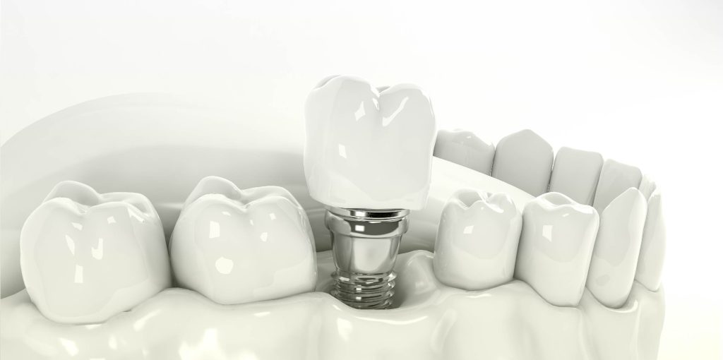 implantes dentales en cáceres